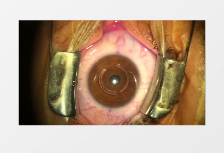 眼科病人眼球特写实拍视频素材