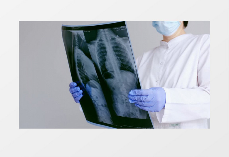 医生在观察患者的胸片实拍视频素材