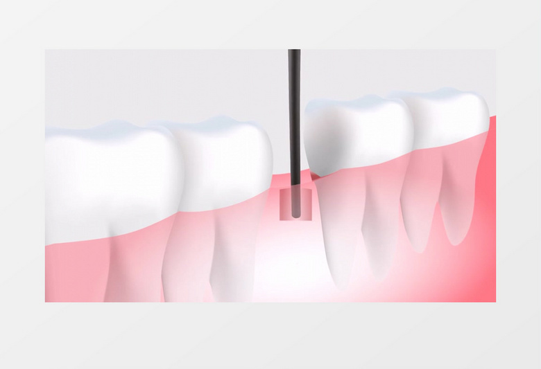 3D效果模拟种植牙齿过程植入种植补牙视频素材