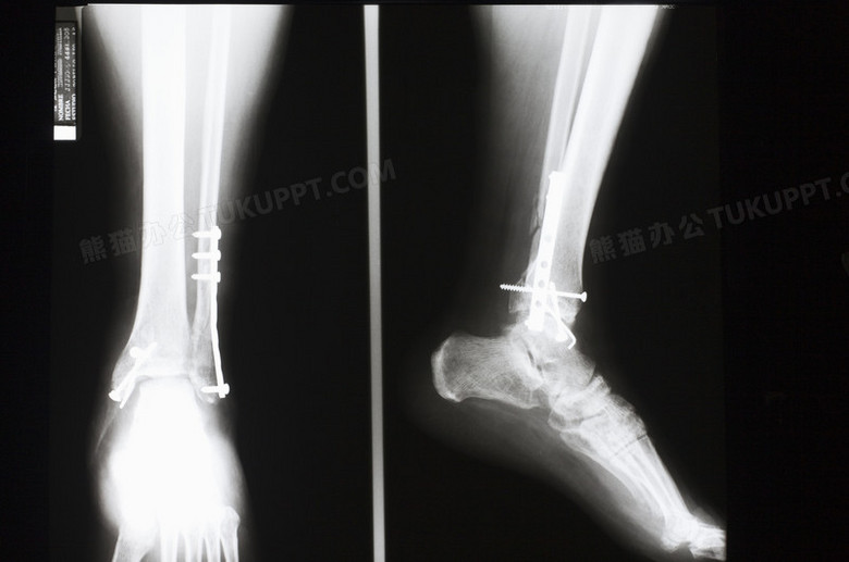 被钉钉子修复中的脚踝骨透视片