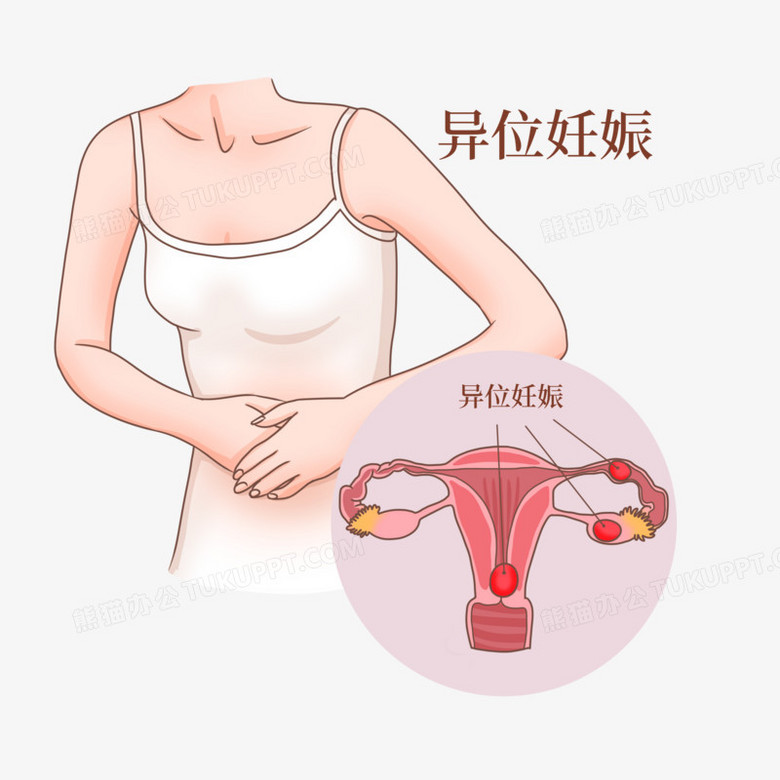 一组手绘孕妇女性医疗疾病科普之异位妊娠素材