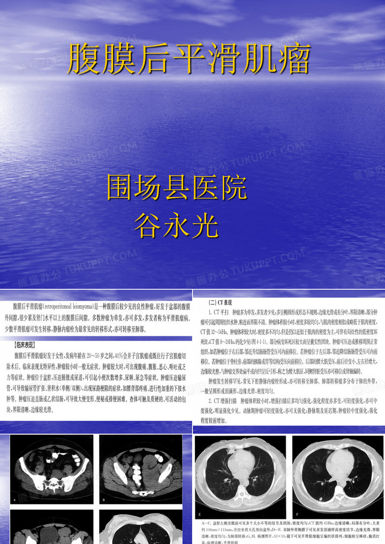 腹膜后平滑肌瘤