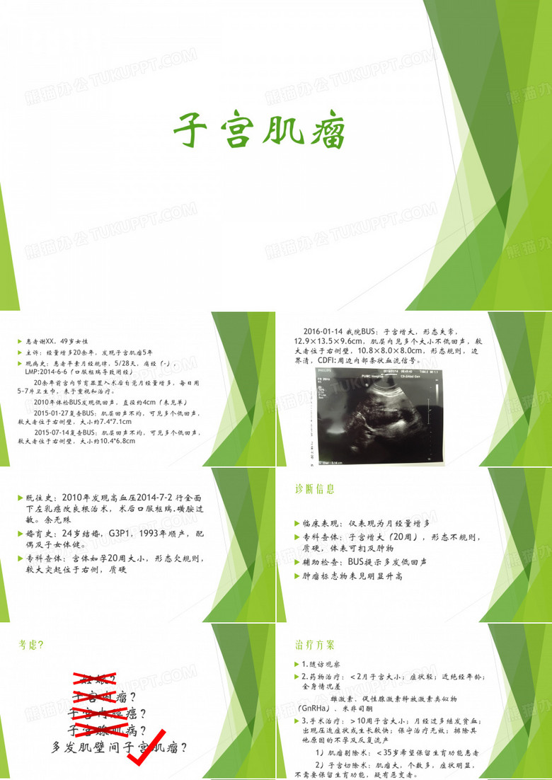 子宫肌瘤