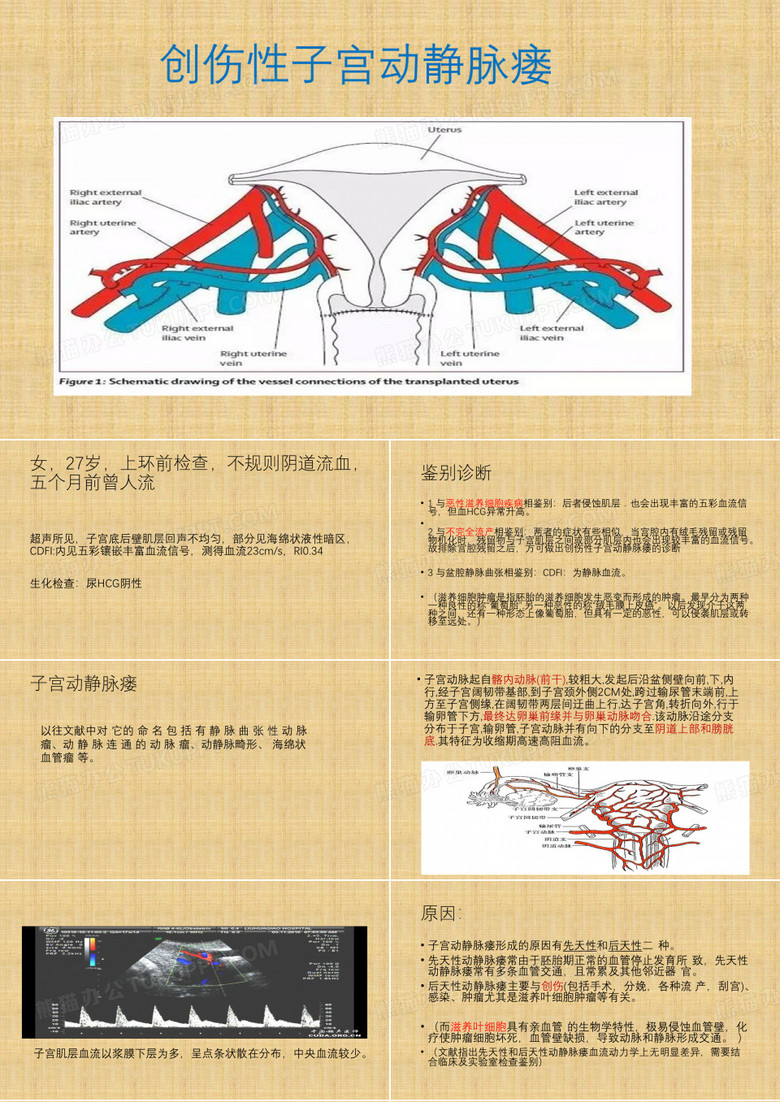 子宫动静脉瘘