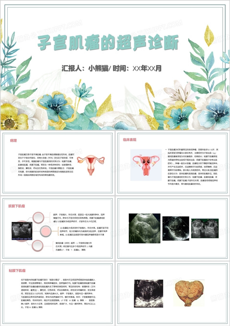 子宫肌瘤的超声诊断PPT模板