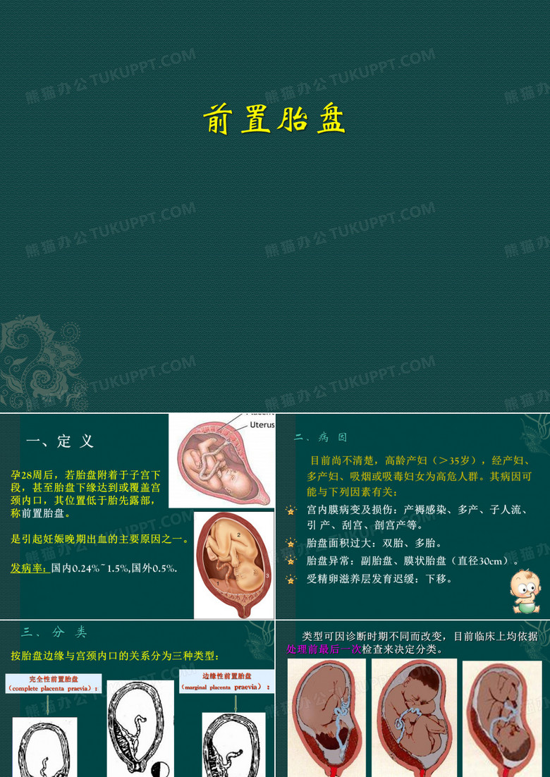 前置胎盘