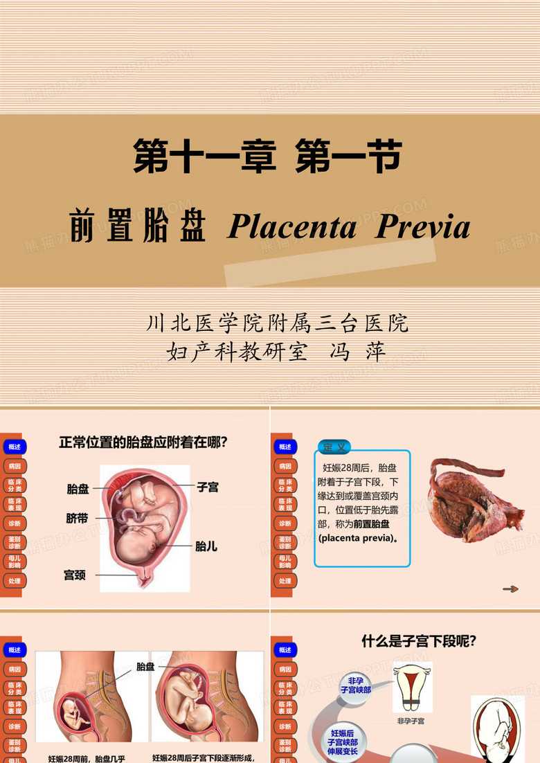 前置胎盘