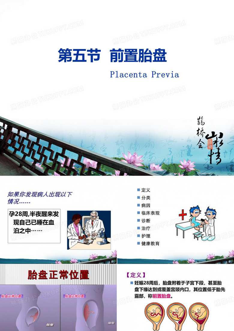 前置胎盘
