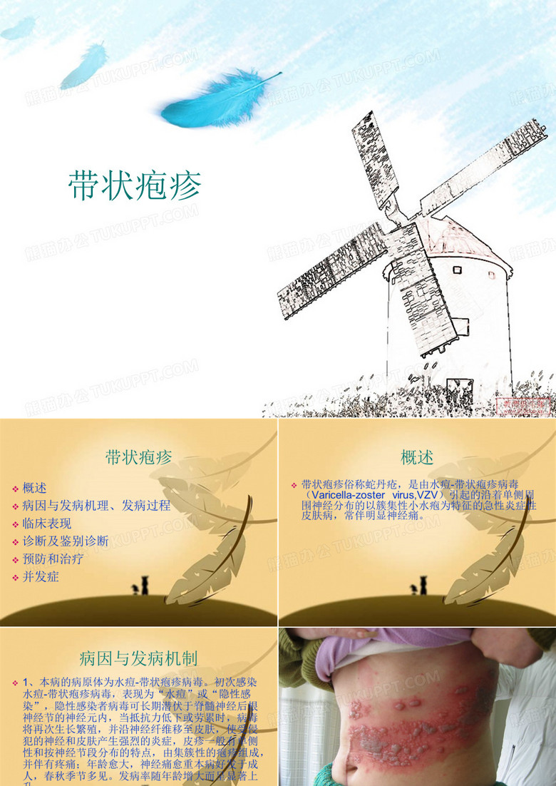 带状疱疹