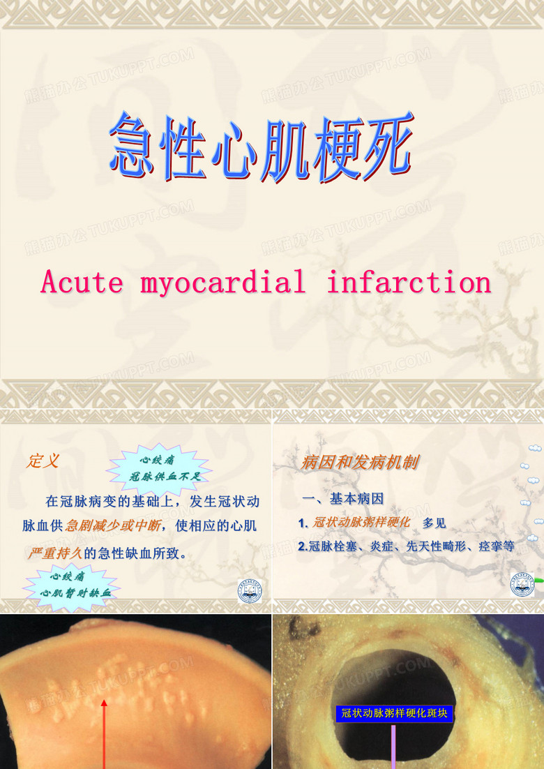 急性心肌梗塞