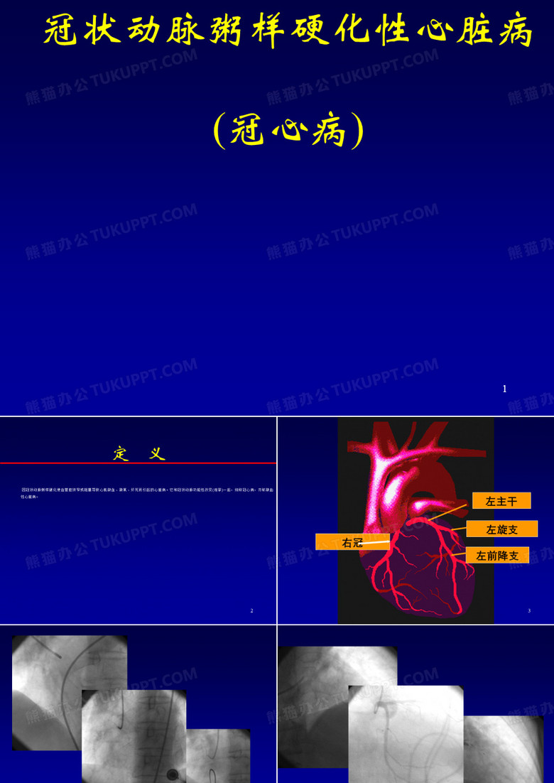 急性心肌梗塞