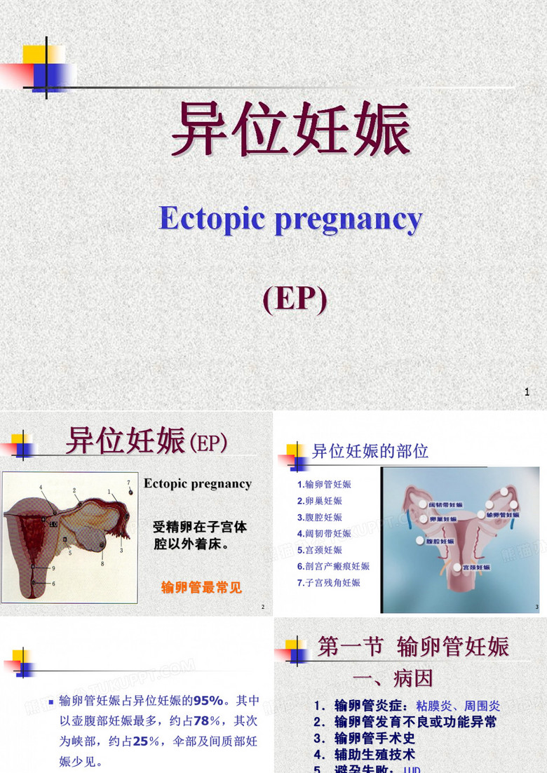 异位妊娠-异位妊娠