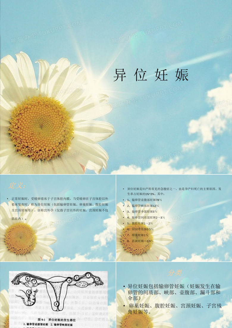 异位妊娠