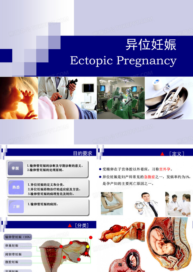 异位妊娠