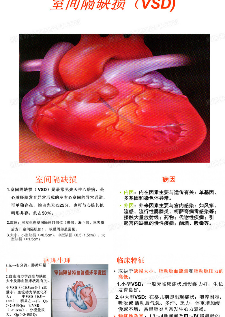 室间隔缺损的护理