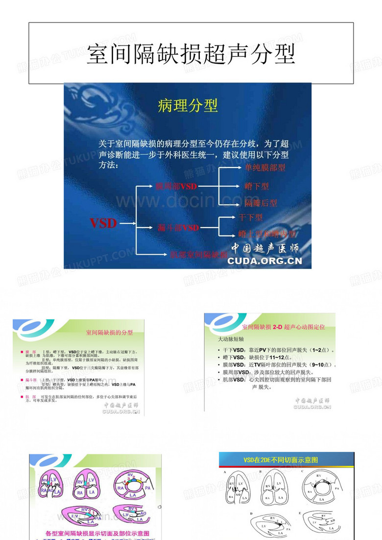 室间隔缺损超声分型