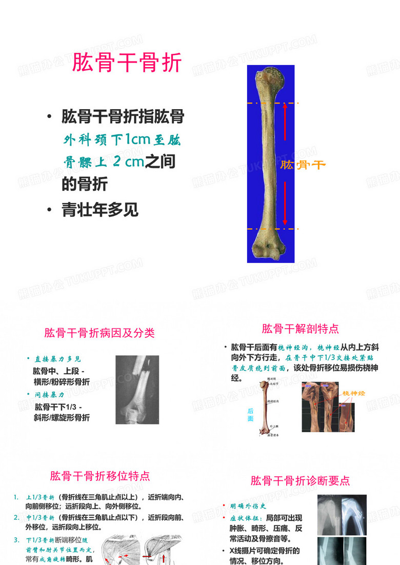 肱骨干骨折
