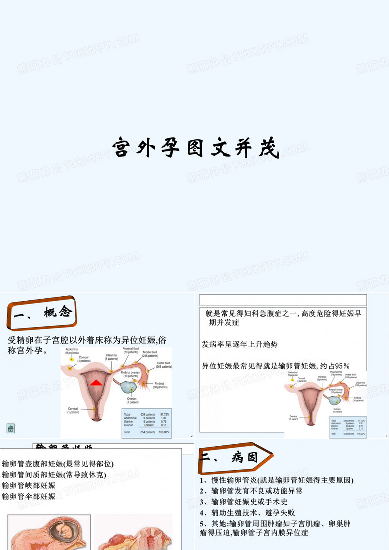 宫外孕图文并茂