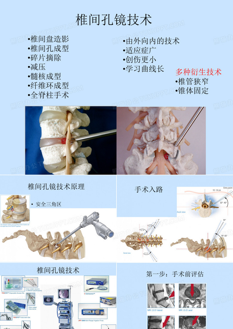 椎间孔镜技术