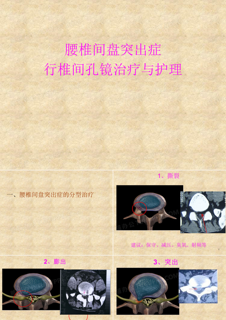 椎间孔镜治疗与护理