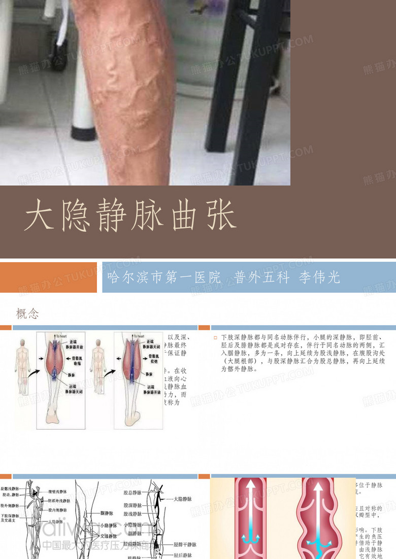 大隐静脉曲张