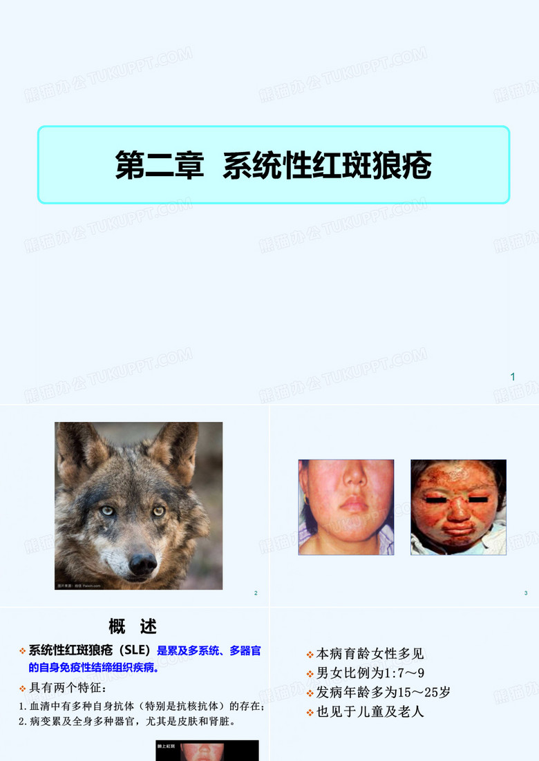系统性红斑狼疮
