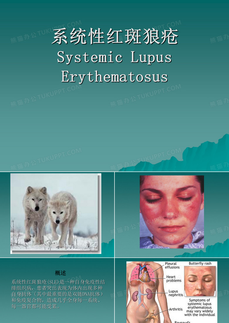 系统性红斑狼疮