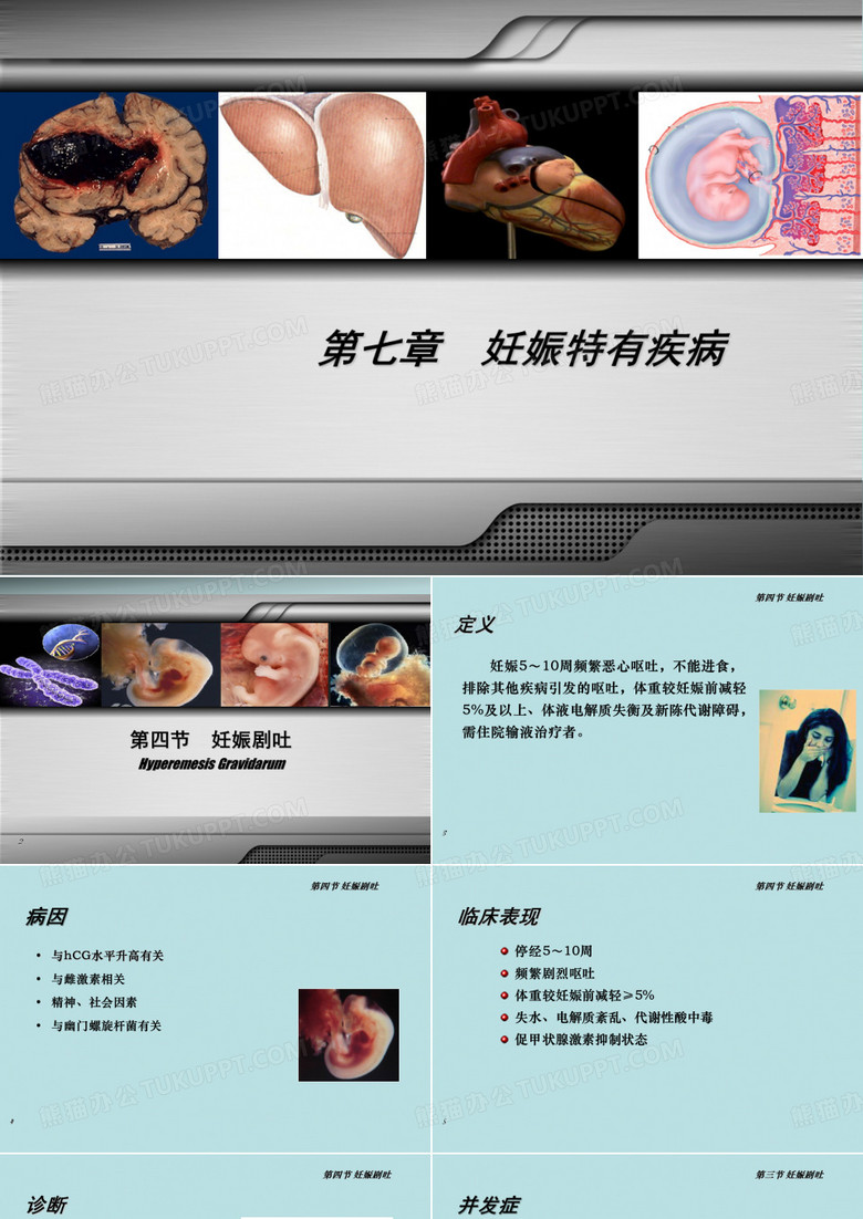 妊娠剧吐