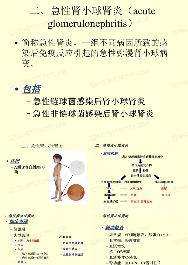 急性肾小球肾炎