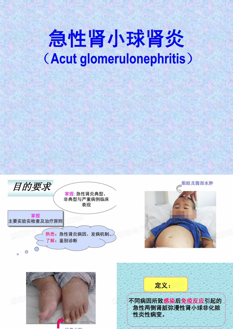 急性肾小球肾炎