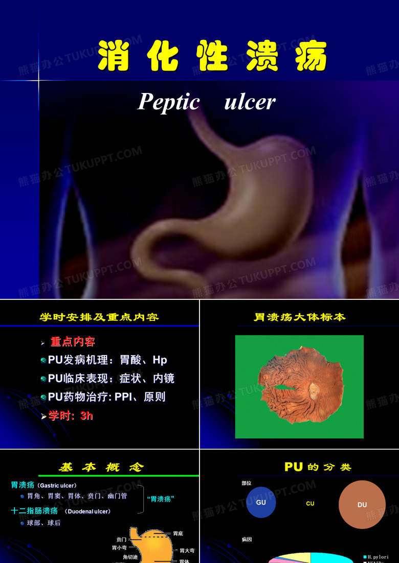 消化性溃疡