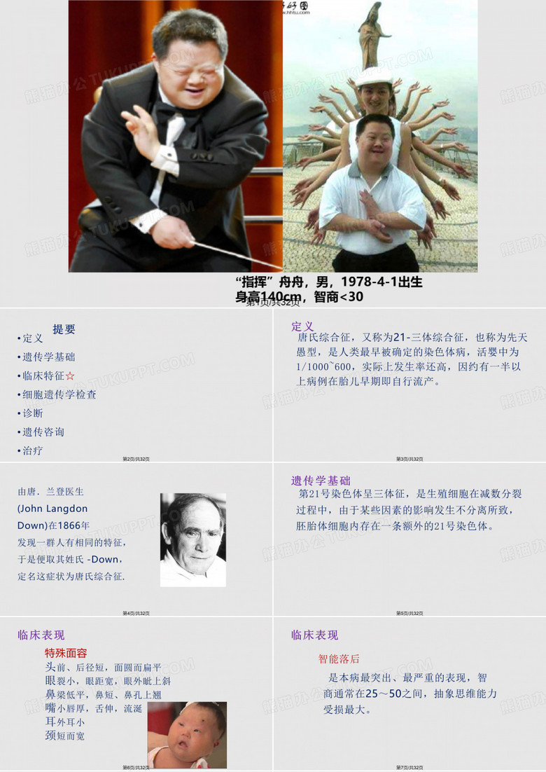 唐氏综合征PPT课件