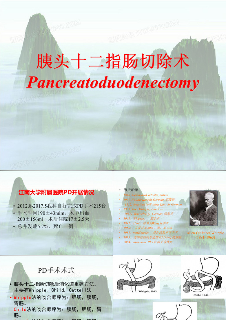 胰头十二指肠切除术