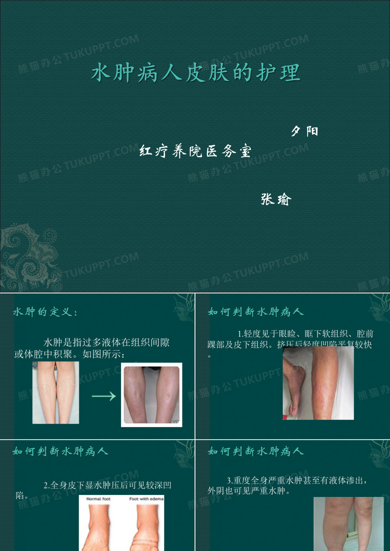 水肿病人的护理