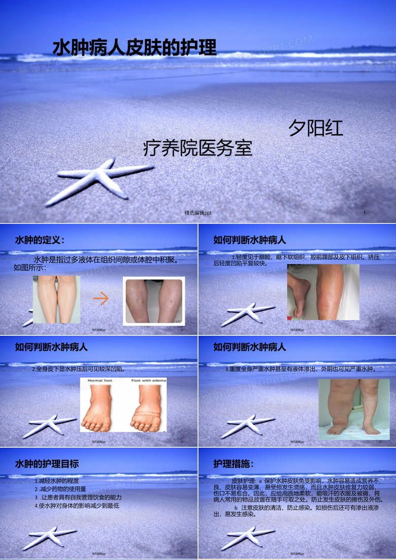 水肿病人的护理ppt课件
