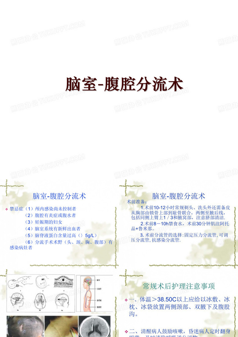 最新脑室-腹腔分流术