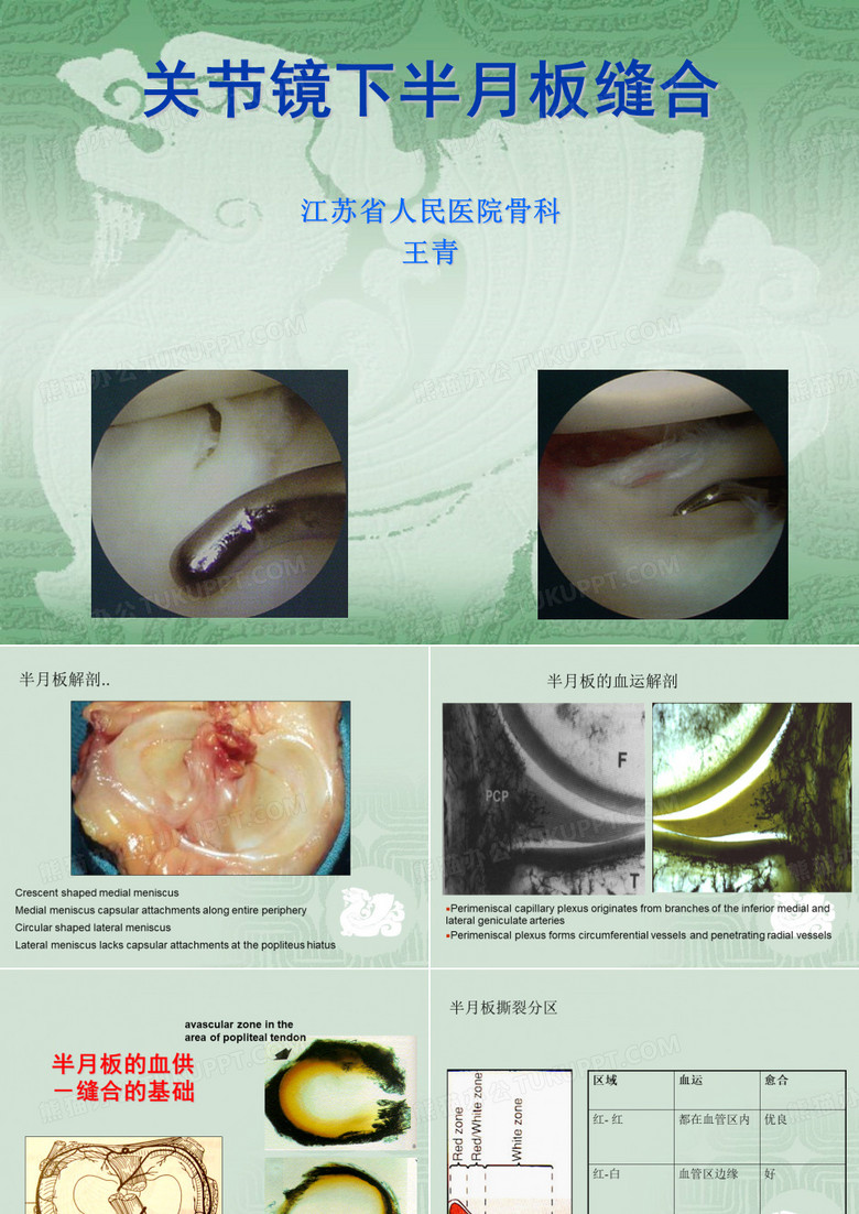 半月板缝合