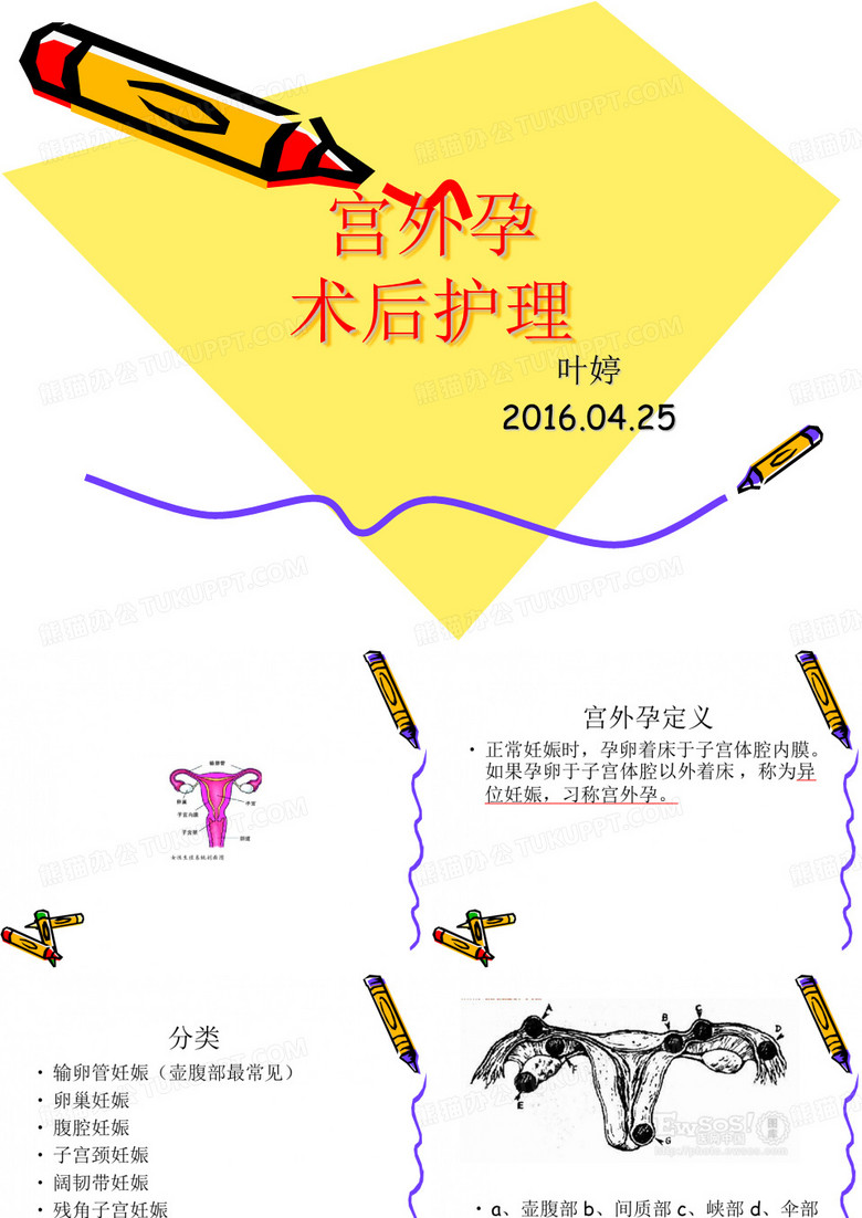 宫外孕护理查房