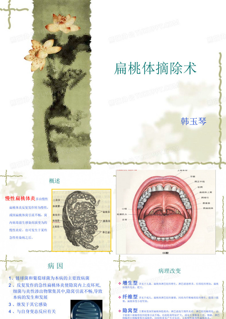 扁桃体摘除术