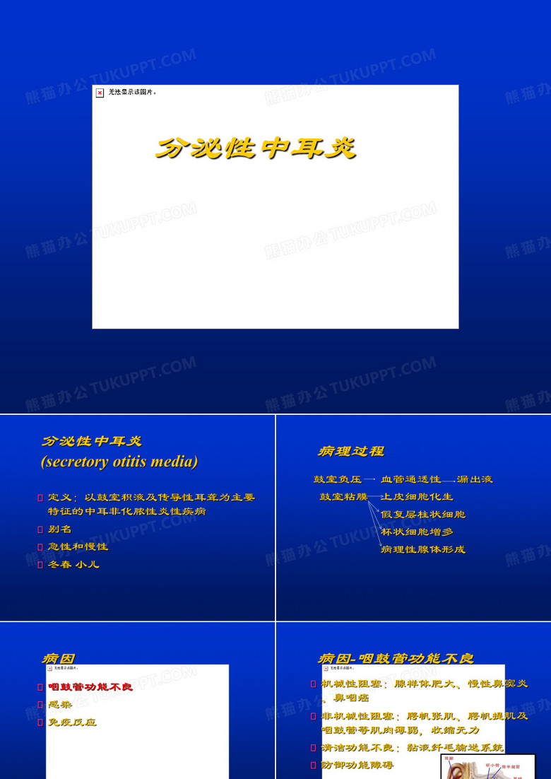 分泌性中耳炎