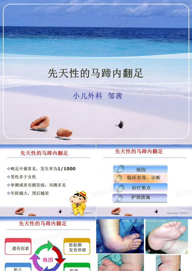 先天性马蹄足ppt