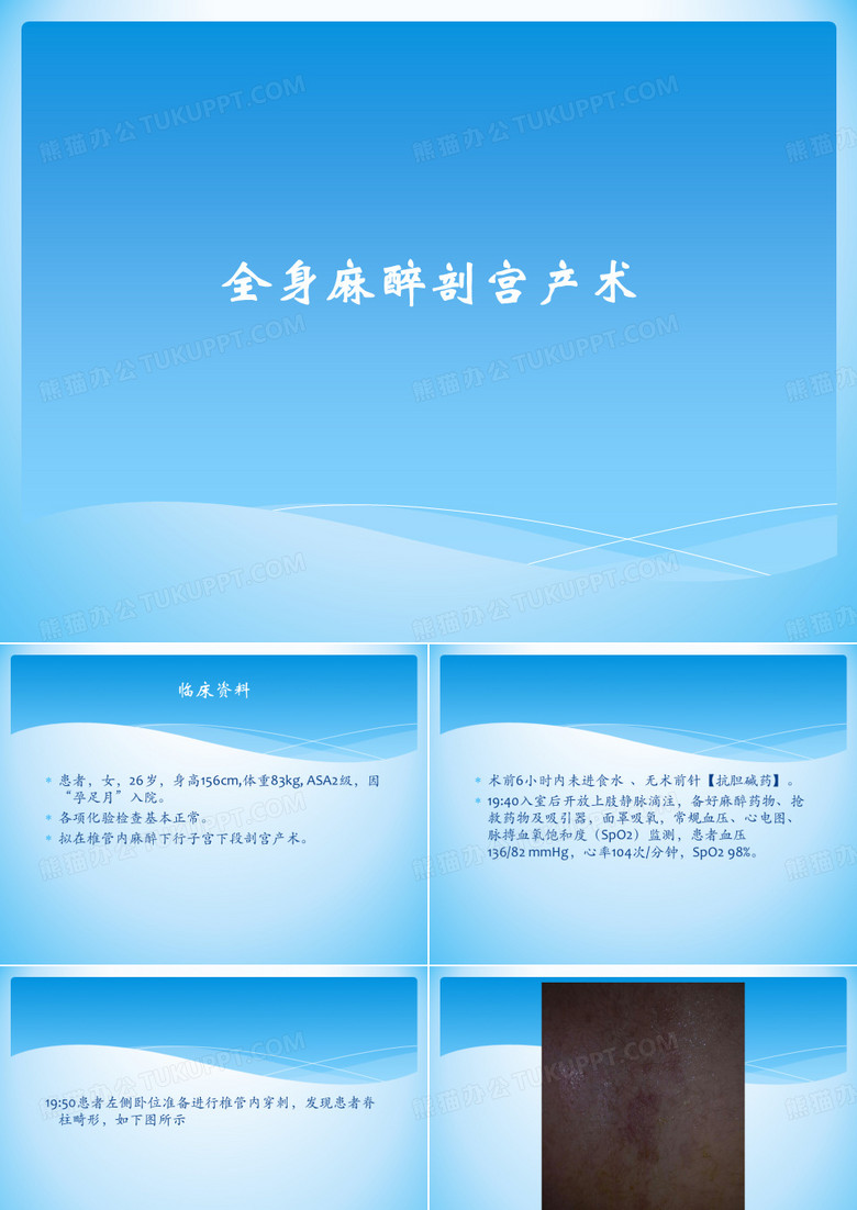 全麻剖宫产