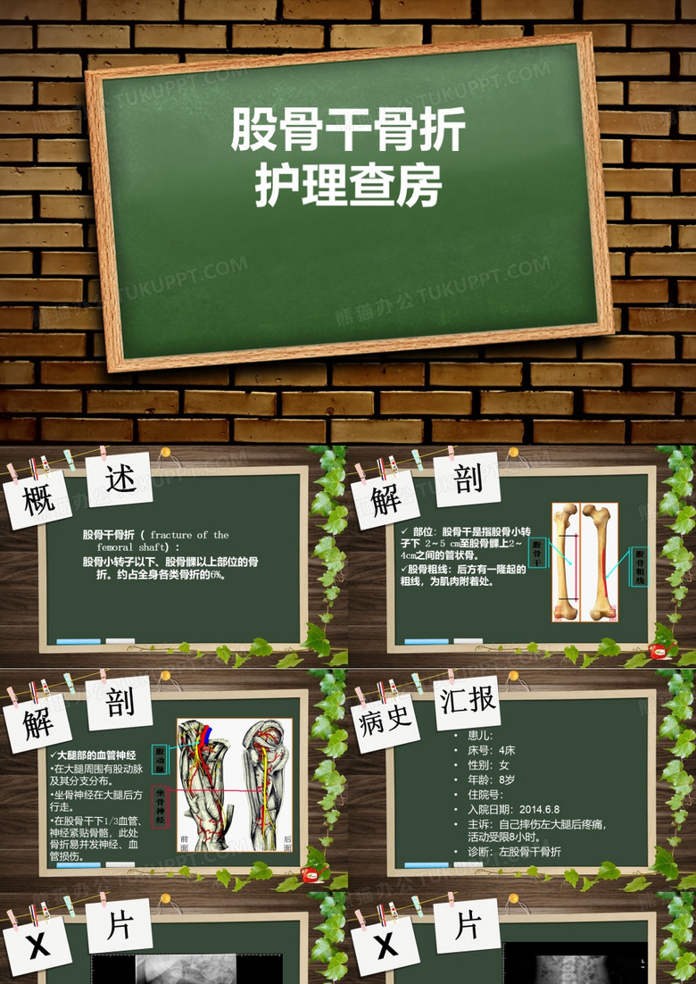 股骨干骨折 护理查房