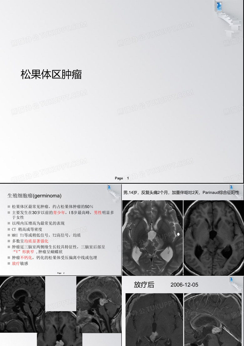松果体肿瘤