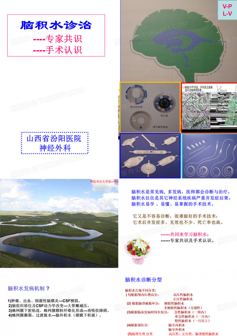 脑积水-讲稿