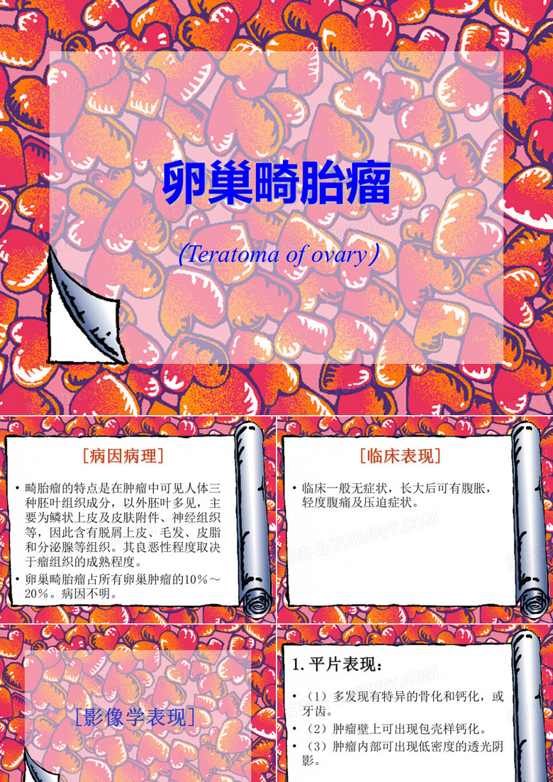 卵巢畸胎瘤