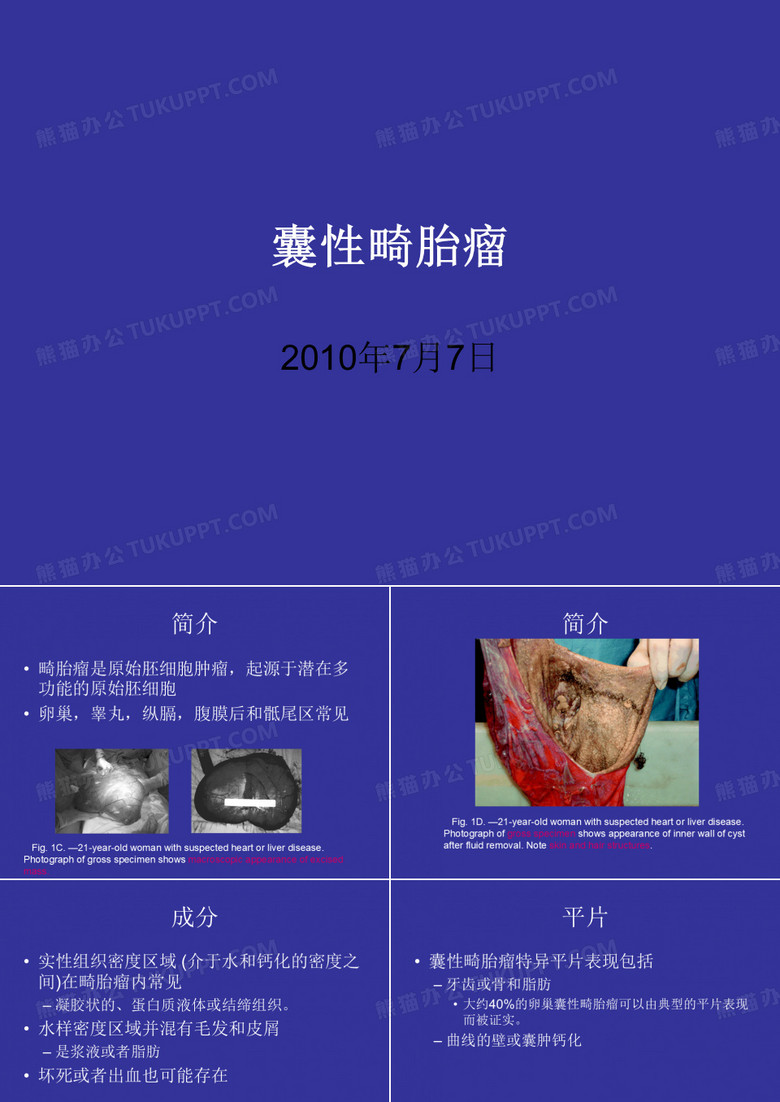 囊性畸胎瘤
