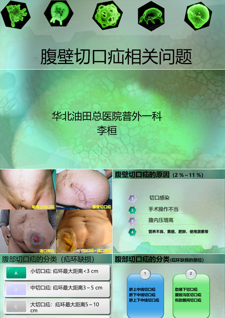 腹壁切口疝