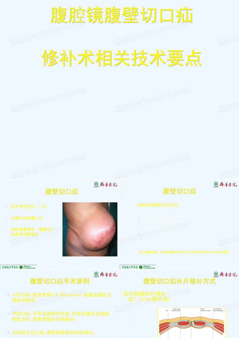 腹腔镜腹壁切口疝修补术