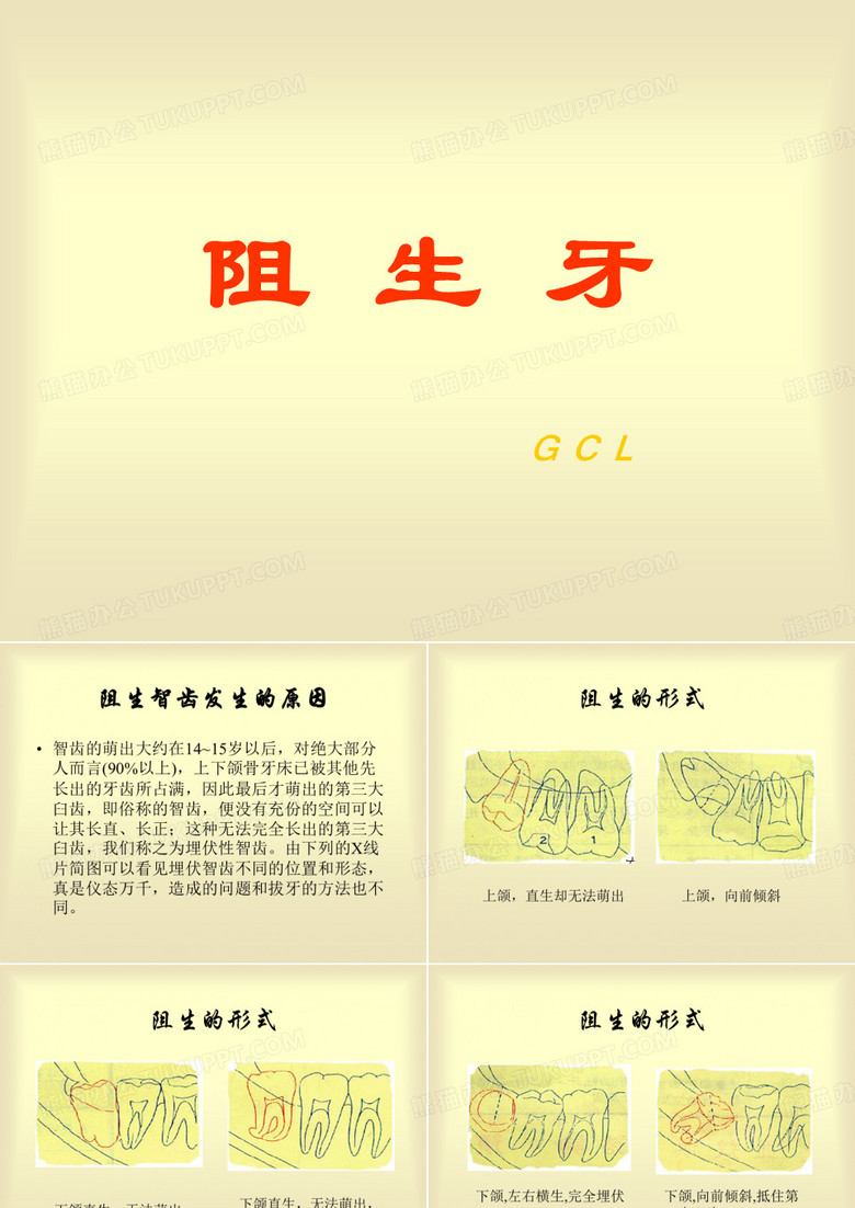 阻生牙